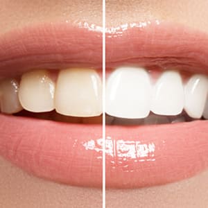 輝く白い歯のホワイトニング