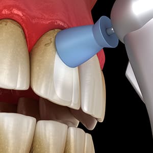 歯のクリーニング・メンテナンス